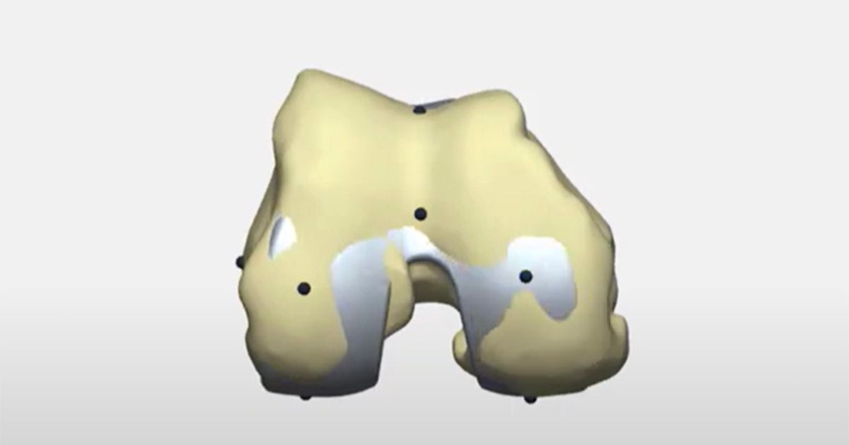 How to personalize knee alignment with 3D planning and guides