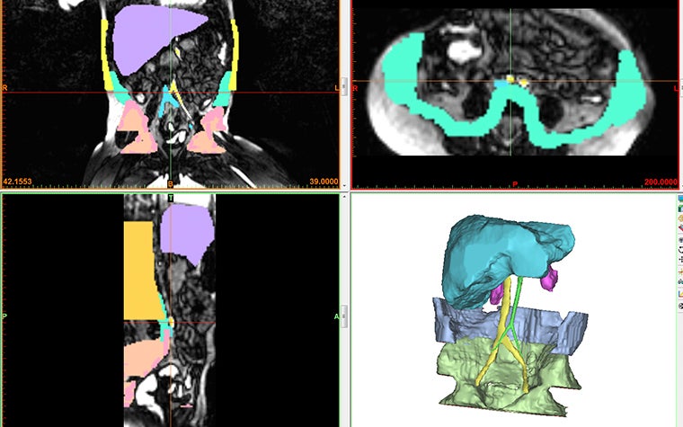 3D visualization alongside patient scans in Materialise Mimics