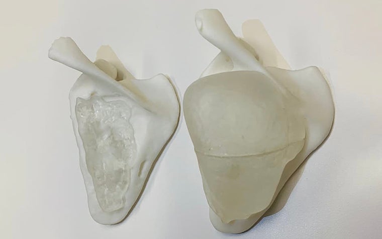 3D-printed anatomical models of a tumor showing reduced size after treatment with chemotherapy 