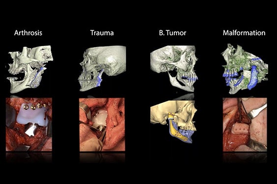 Four scans showing TMJ pathologies: arthrosis, trauma, B. tumor, and malformation. Below are images of the implants attached to the patients