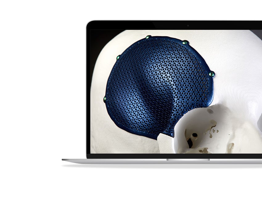 A 3D-printed, porous, titanium CMF implant shown on a skull.