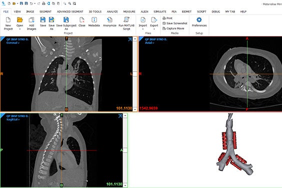 Views of the tracheal splint and patient anatomical scans in Materialise software