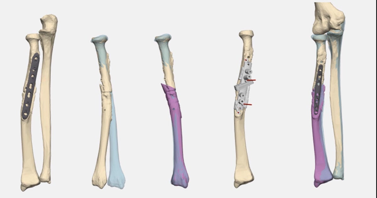 Revista Brasileira de Ortopedia - Treatment of Distal Radio Vicious  Consolidation: Corrective Osteotomy Through 3D Printing  Prototyping<sup>*</sup>