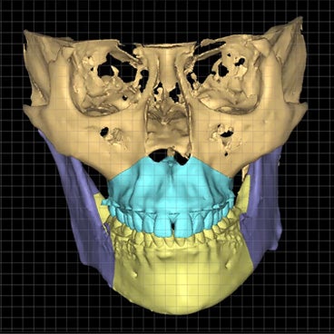 Virtual Planning for Orthognathic Surgery with Mimics Enlight CMF