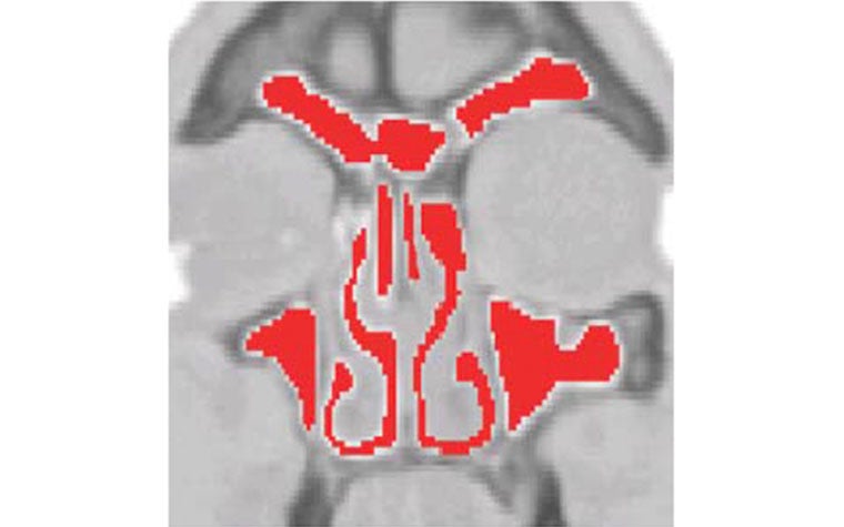 Anatomy scan with red highlights on a patient's inner nasal cavity