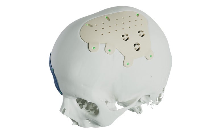 A skull with a PEEK implant fixated on it.