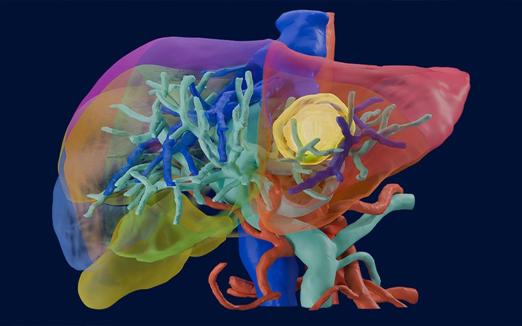 3D medical visualization of the liver with semi-transparent anatomy, showing detailed blood vessels and a highlighted yellow tumor-like mass in the upper section.