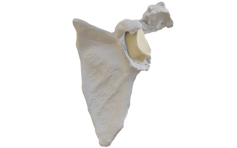 Modell eines Glenoids mit starker Medialisierung