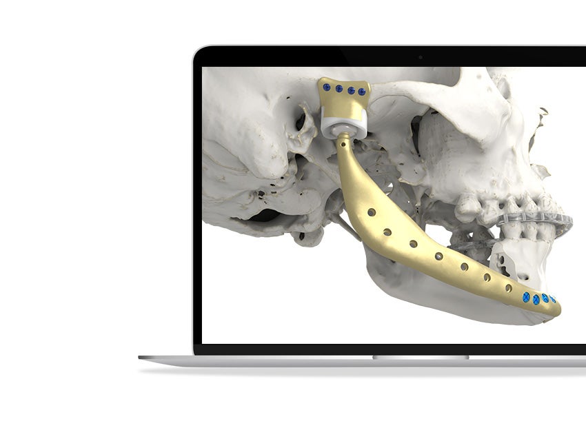 Laptop screen showing the side view of a skull model with a metal implant along the jaw