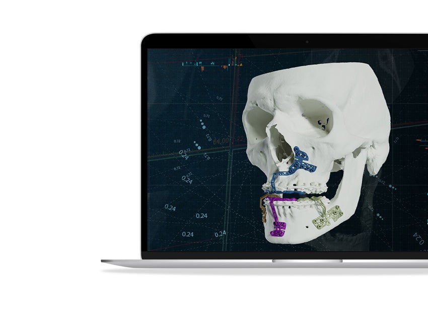 ssd-materialise-cmf-solutions-3d-printed-guides-skull-mios.jpg
