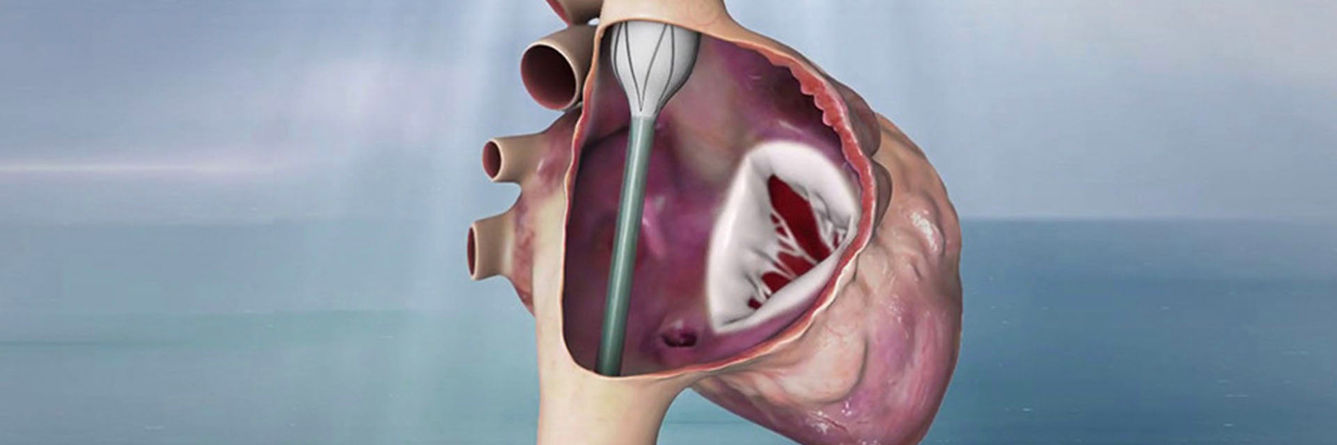 Digital image of a valve replacement