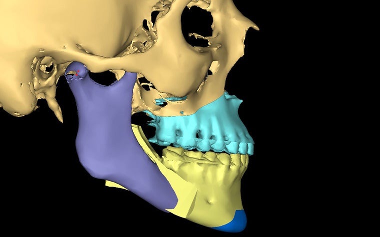 A 3D render of a skull in Mimics Enlight CMF with segmented sections in different colors.