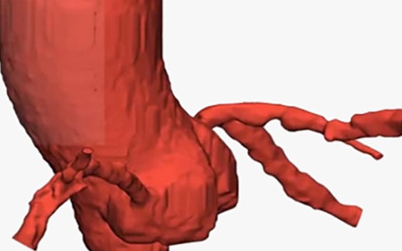 How to Segment and Analyze Coronaries in Mimics Innovation Suite