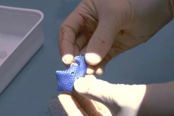 Eines der Gesichtsimplantate, die während des Eingriffs verwendet wurden.