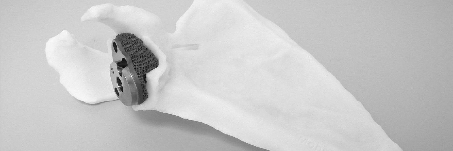 Personalized, 3D-printed implant in a shoulder model