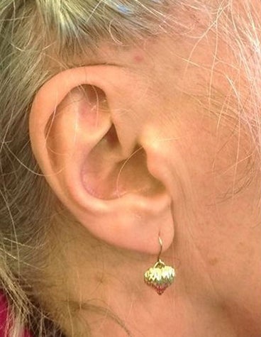 The patient’s ear.