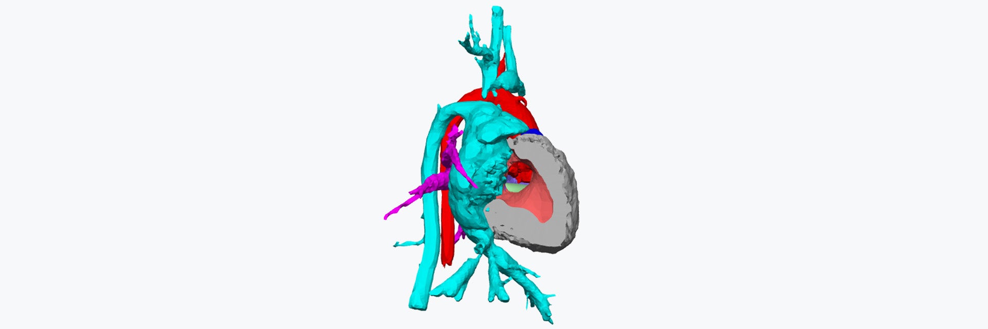 A 3D anatomical rendering of a child's heart and surrounding blood vessels in multiple colors, highlighting internal chambers and vascular structures.