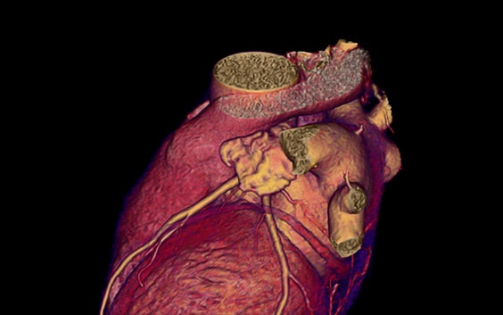 Structural Heart Pre-Procedural Planning | Materialise Healthcare
