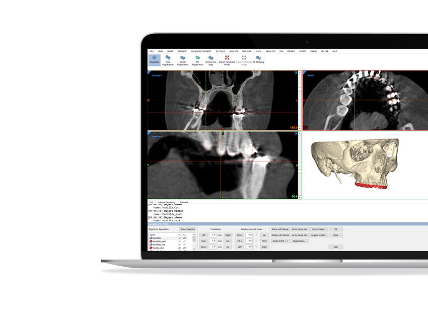 Pantalla que muestra varias imágenes de un cráneo en el módulo de simulación Mimics Innovation Suite.