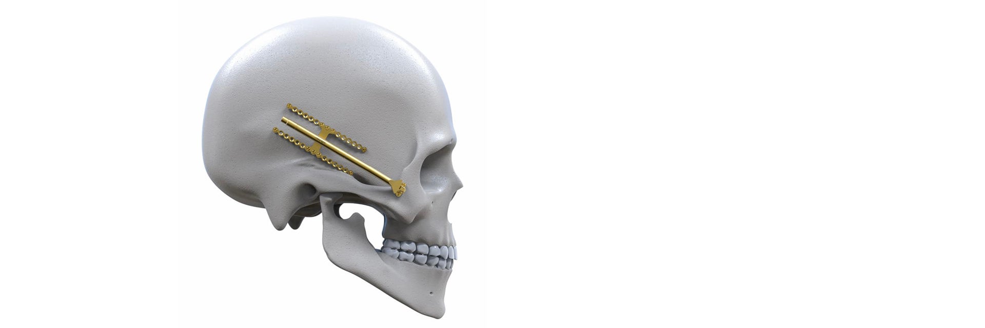 Virtual model of Engimplan implants in the skull