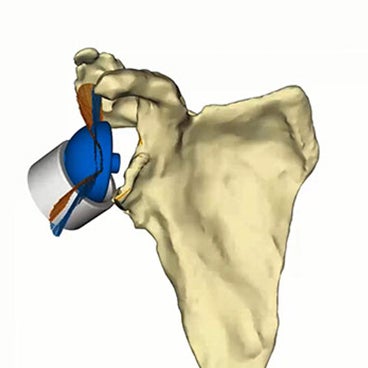 Planning a Glenius Personalized Shoulder Implant with the Clinical Engineer