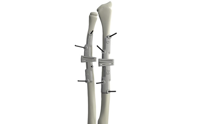 materialise-osteotomies-solutions-3d-printed-guides-indication-forearm-model.jpg