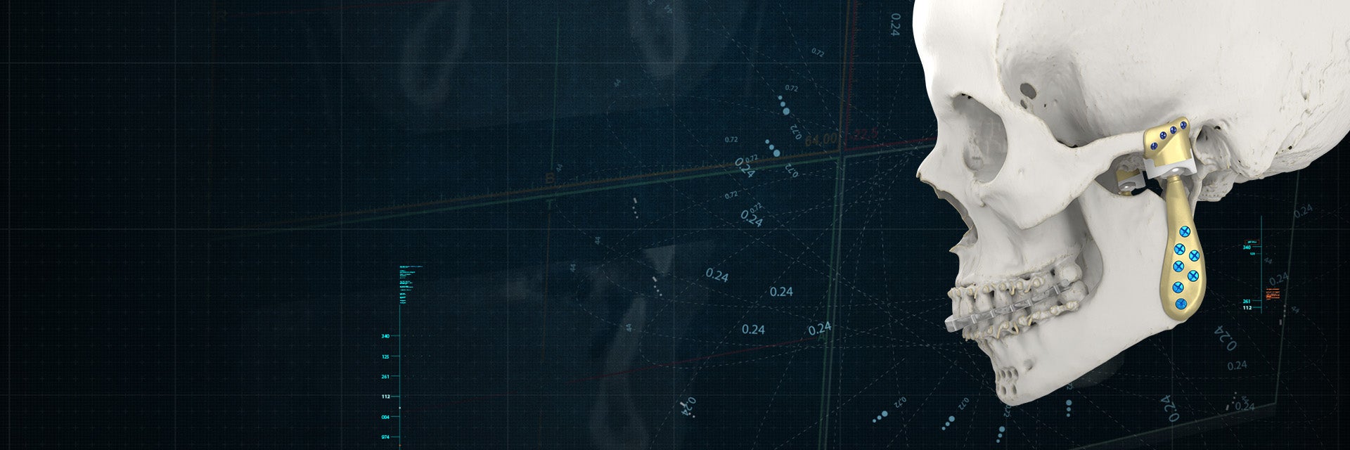 Side view of a skull model with personalized TMJ implants attached
