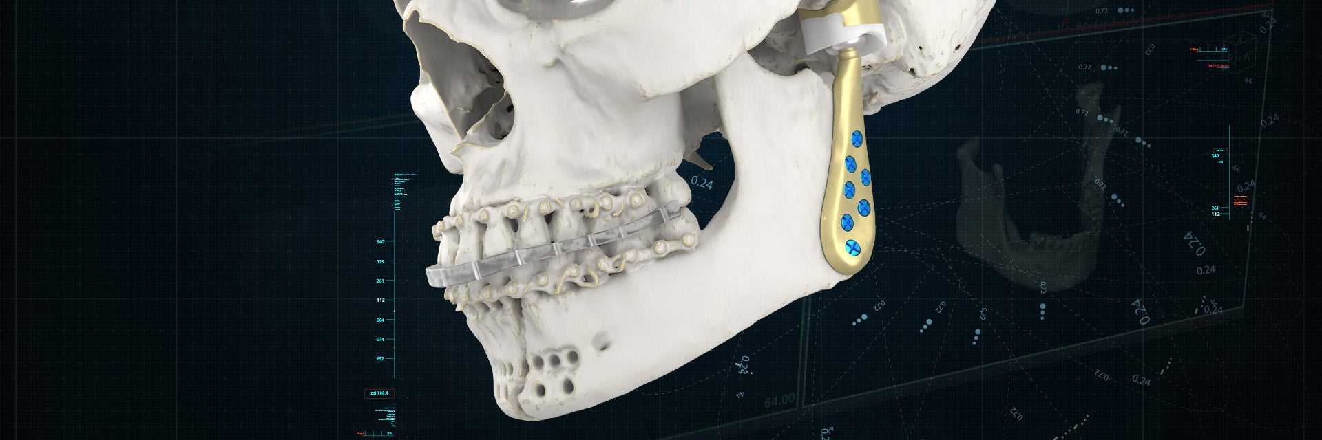 A skull model with a 3D-printed, personalized TMJ implant attached