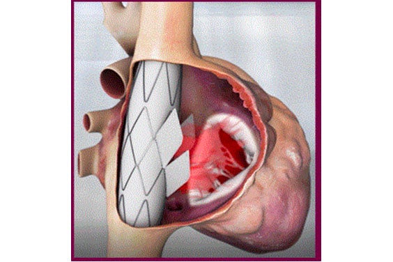 Digital image of a valve replacement