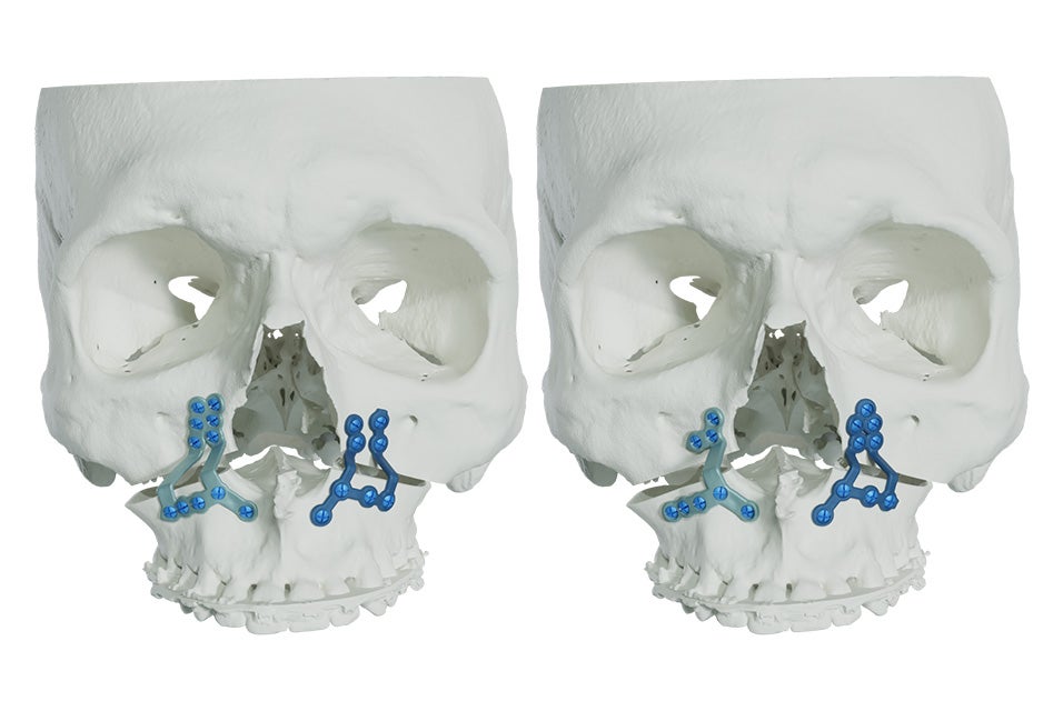 Two front facing skulls side by side with 3D-printed minimally invasive guides for LeFort procedure.