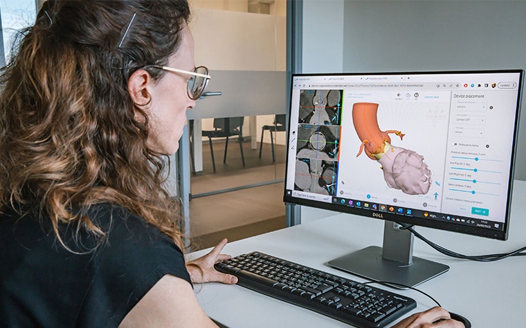 A woman looking at a computer screen showing the anatomical overview of an aortic root on SurgiCase software