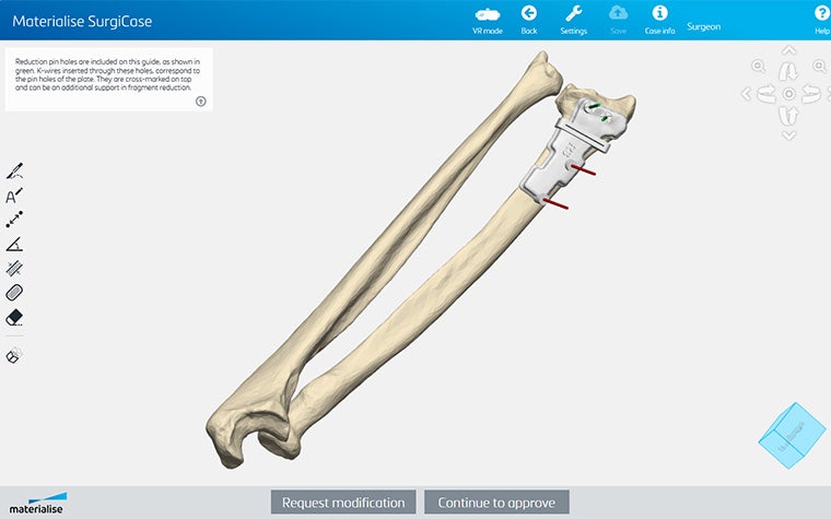 Screenshot der SurgiCase-Software, der ein Knochenmodell mit einer personalisierten, 3D-gedruckten Schnittführung zeigt