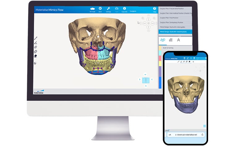 A computer screen and smart phone displaying Mimics Flow with a segmented skull and personalized 3D-printed implants