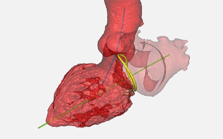手術計画ツールを備えた心臓の3Dデジタルモデル