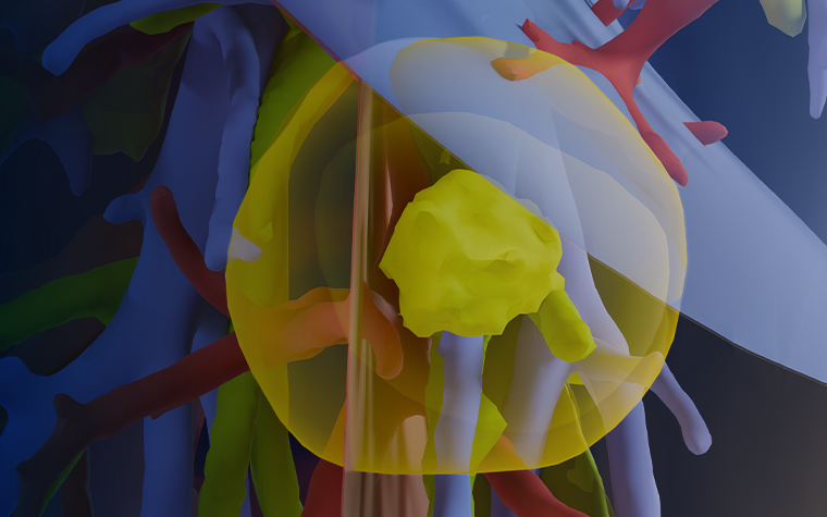 A 3D medical visualization showing semi-transparent anatomy with highlighted blood vessels and a yellow tumor in the lung.