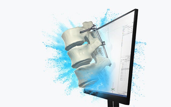 Computer screen with the Mimics Innovation Suite software and a bone with a metal corrective device popping out of the screen.