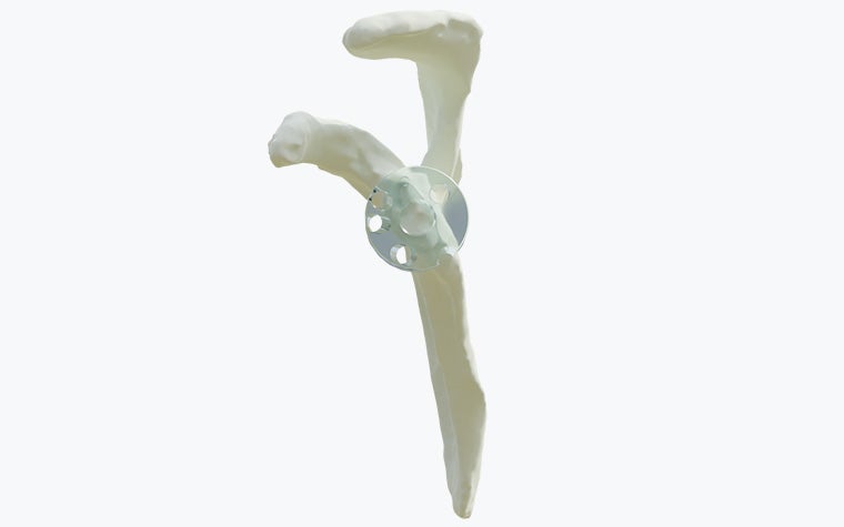 Virtual model of a shoulder with a completely eroded glenoid vault