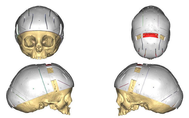 4 angels of a skull model with personalized cutting guides attached