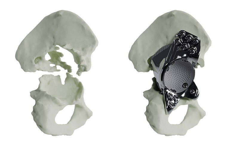 severe-pelvic-discontinuity-without-with-implant-model.jpg