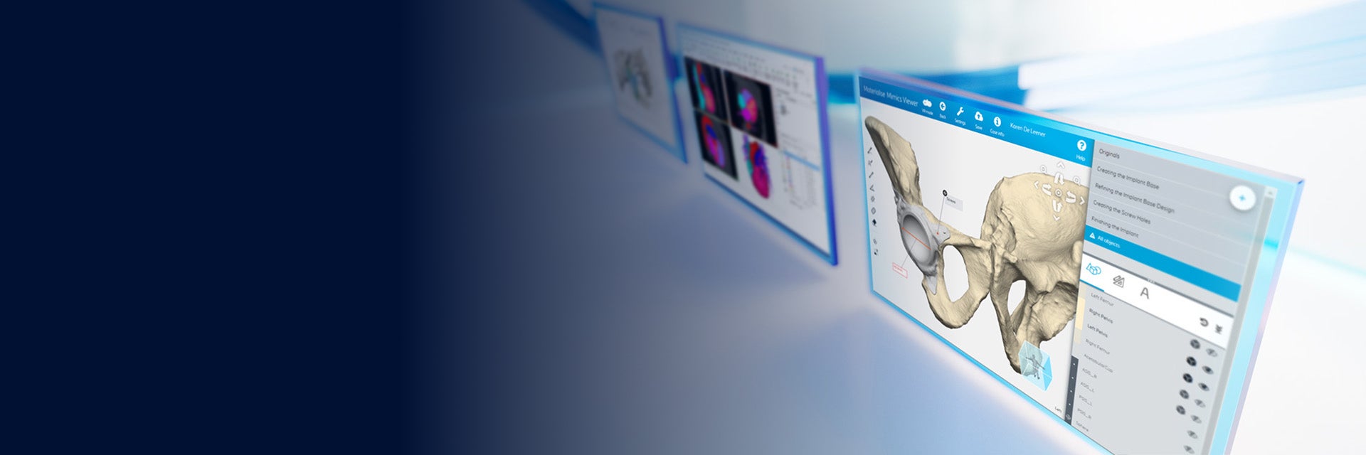 Three screens showing patient anatomy within software from the Materialise Mimics platform on a white reflective background with blue lines