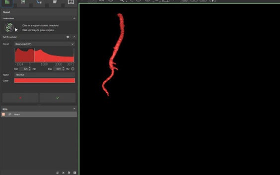 Capture d'écran de la segmentation vasculaire