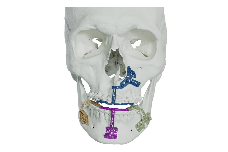 A front facing skull with personalized tooth supported minimal invasive guides.