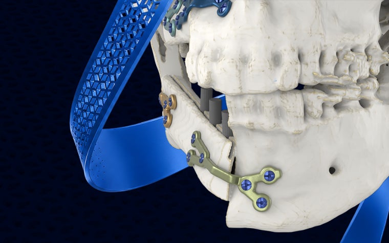 Vorderansicht eines Kiefers mit der Materialise S-Platte eingesetzt links und rechts