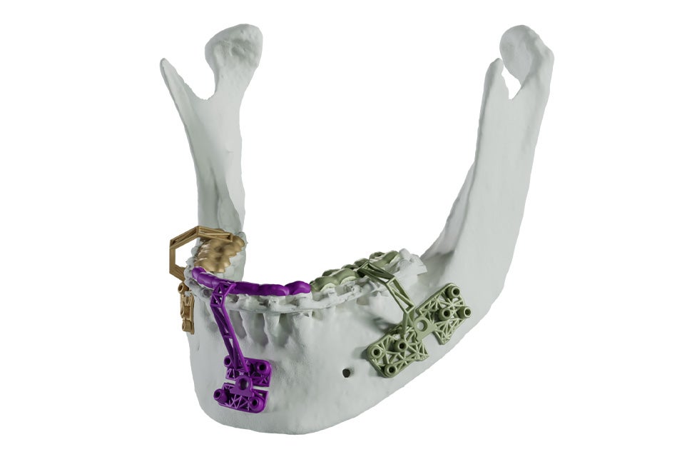 The jaw bone personalized tooth-supported minimally invasive guides for BSSO and genioplasties.