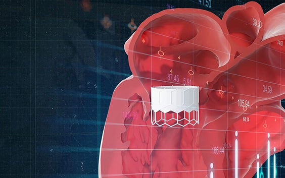 Materialise HeartPrint  3D-Printed Cardiovascular Models