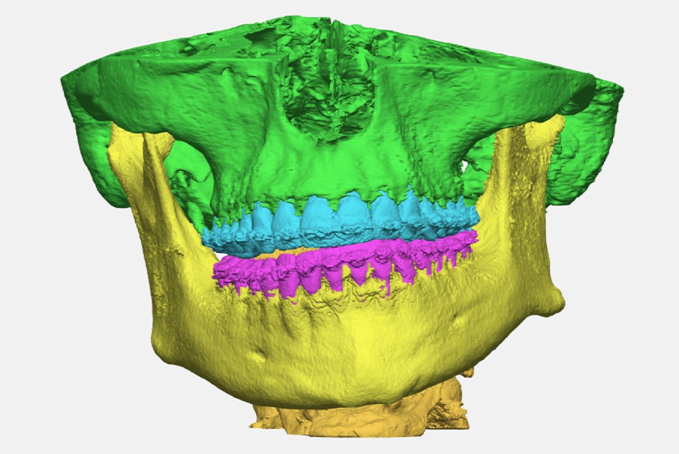 A 3D model of a segmented skull/jaw anatomy