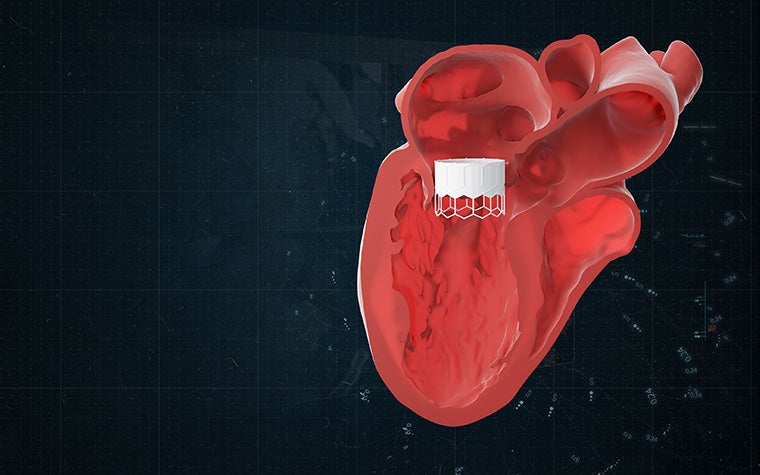 Digital image of a cross section of a heart with a TMVR device implanted