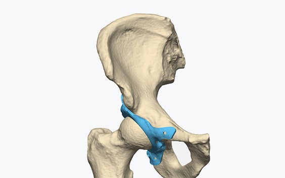Hip bone visualized in 3D with an implant on top