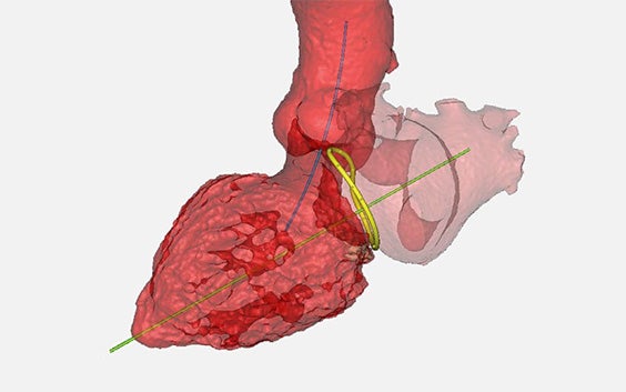 3D digital model of a heart with planning tools for surgery