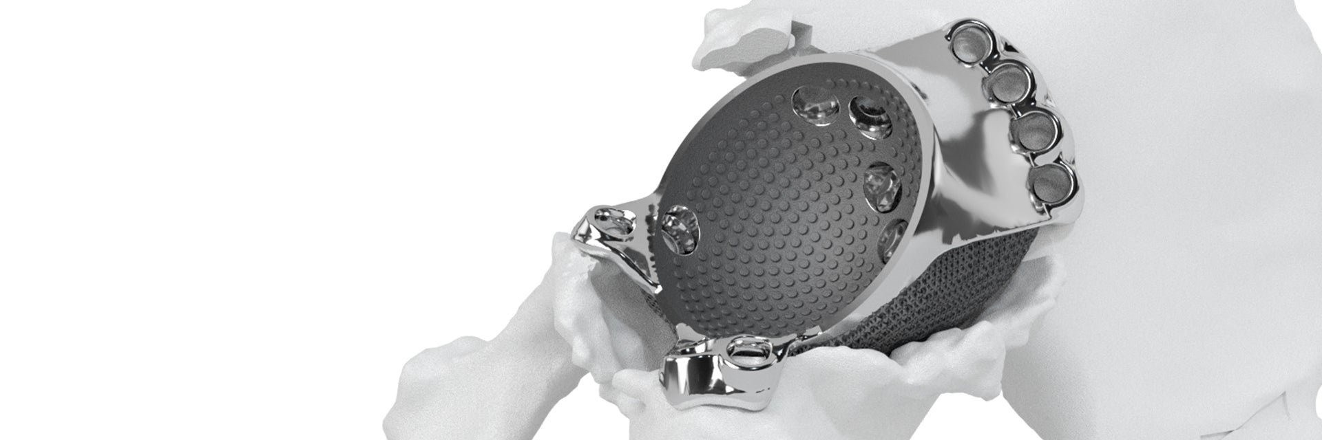 Personalized aMace hip implant shown in a hip bone model